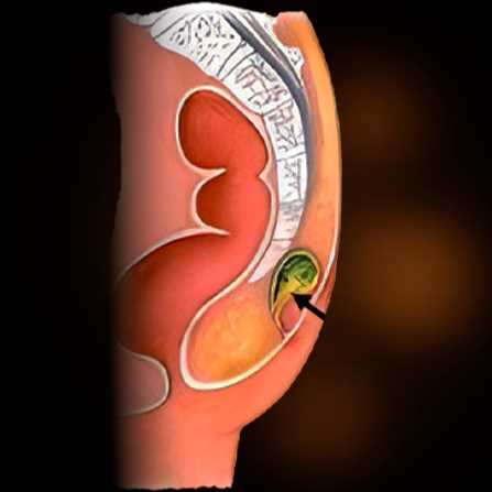 Pilonidal cyst surgery